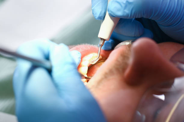 Best Dental Abscess Treatment in South Wilton, CT