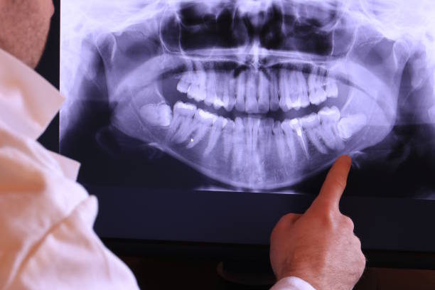 Best Emergency Wisdom Tooth Extraction in South Wilton, CT